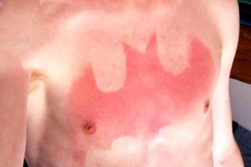 Ora il tatuaggio si fa scottandosi È la sunburn art, moda da evitare