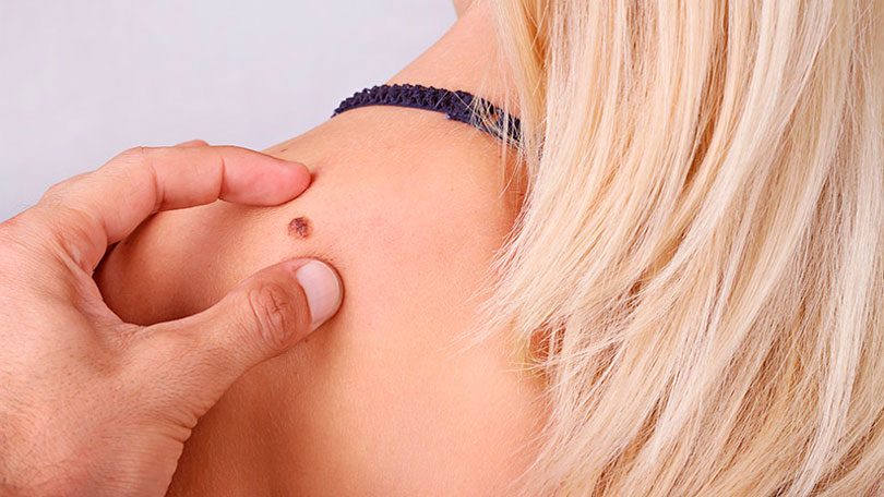 Essere sposati può salvare la vita (stiamo parlando di melanoma)