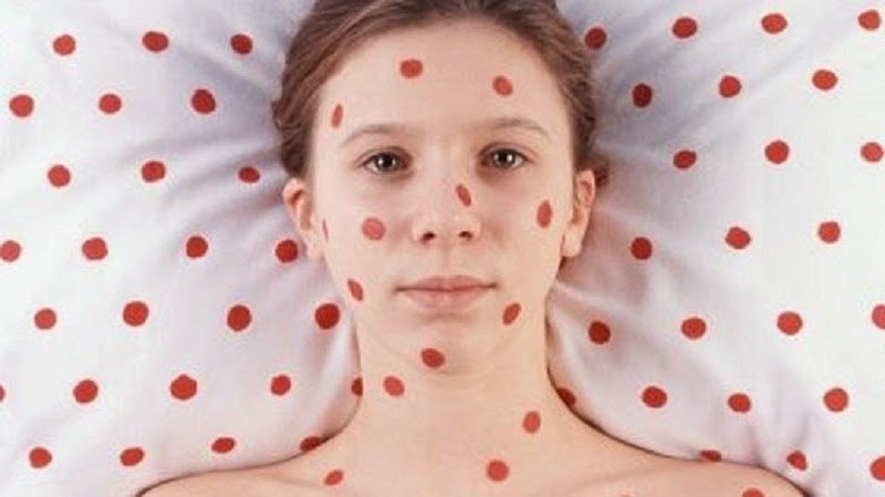 Le otto cose da sapere sul morbillo