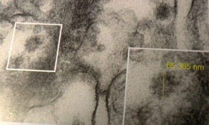 Il Coronavirus fotografato nel rene: l'importante scoperta dell'Istituto Mario Negri