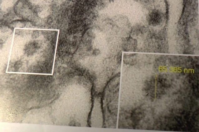 Il Coronavirus fotografato nel rene: l’importante scoperta dell’Istituto Mario Negri