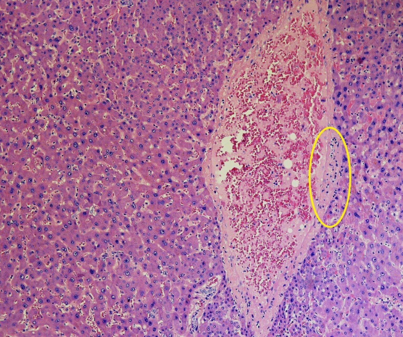 Il primo studio sui danni del Covid-19 al fegato è del Papa Giovanni in collaborazione con Yale