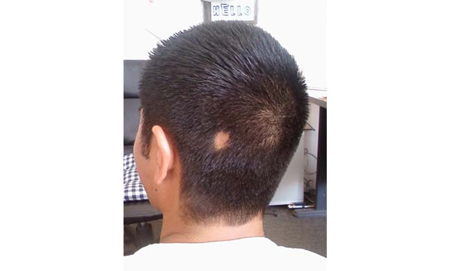 L’alopecia è una condizione di disagio per sempre più uomini e donne. Esistono rimedi efficaci?