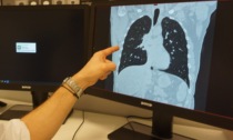 Tumore del polmone, al via le iscrizioni allo screening gratuito al Papa Giovanni XXIII