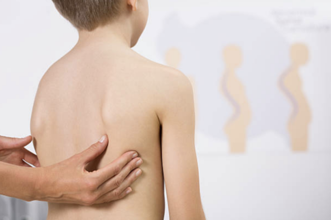 La scoliosi nei bambini e negli adolescenti