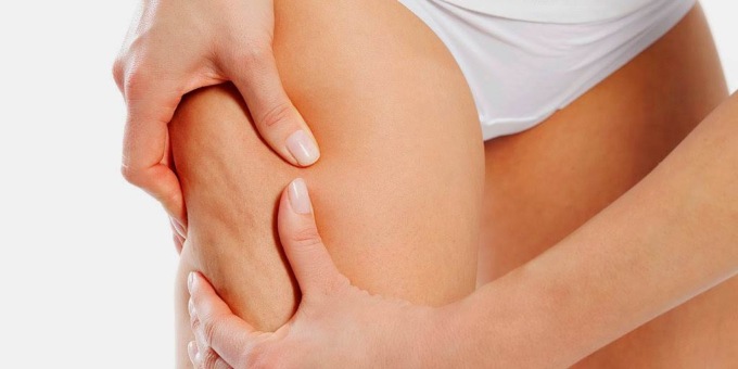 Cellulite, come combatterla? Stili di vita e trattamenti indolori