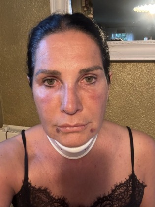 Lara Magoni tamponata da un carroattrezzi: «Un’auto ferma sulla strada, ho inchiodato e…»