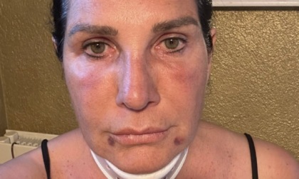 Lara Magoni tamponata da un carroattrezzi: «Un'auto ferma sulla strada, ho inchiodato e...»