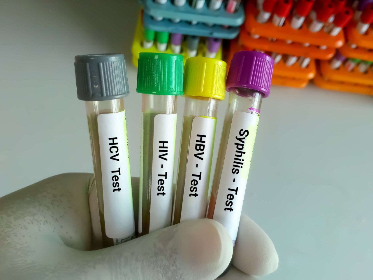 Arrivano a Bergamo (in via Madonna del Campi) i test rapidi per le malattie sessualmente trasmissibili